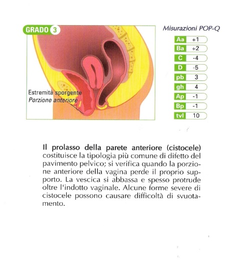 Chirurgia del prolasso della vescica e dell'utero - Cistite.info APS