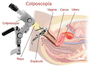 colposcopia1