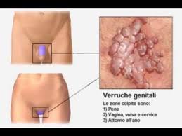 papilloma virus vescicale sintomi remedii eficiente pentru tratamentul negi genitale