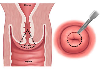 Terapia dell'HPV - Cistite.info APS