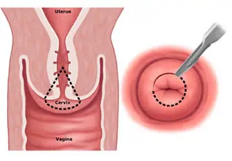 cum să eliminați condilomii din vagin