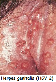 Vaginalis herpes What is
