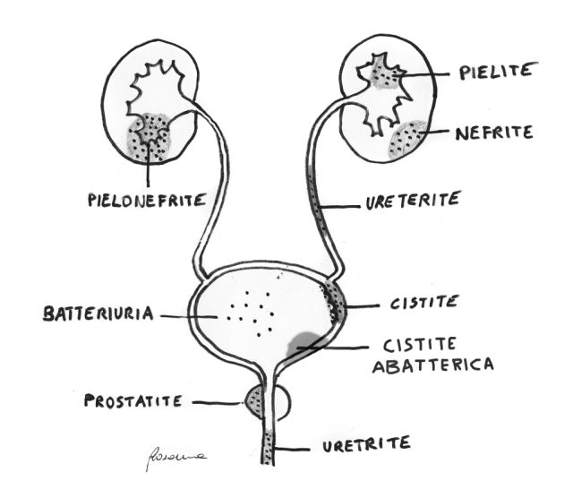 Fig. 8: Infezioni urinarie: i puntini sono i batteri, in grigio le zone infiammate